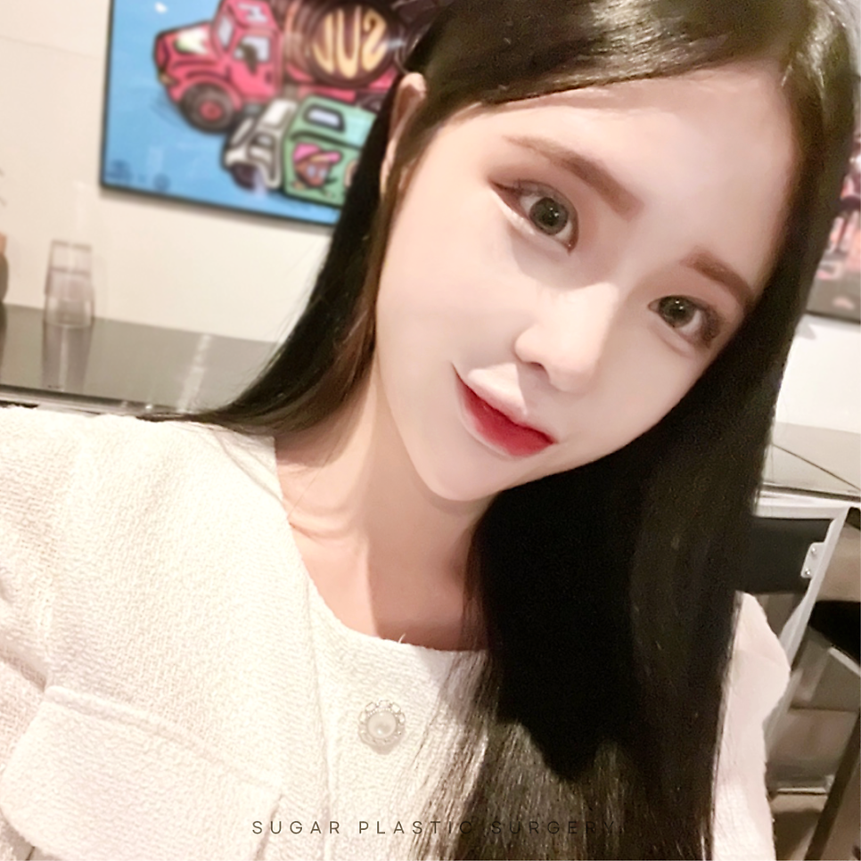 라인높이기 눈재수술 이것만은 알고가자 관련 이미지 5