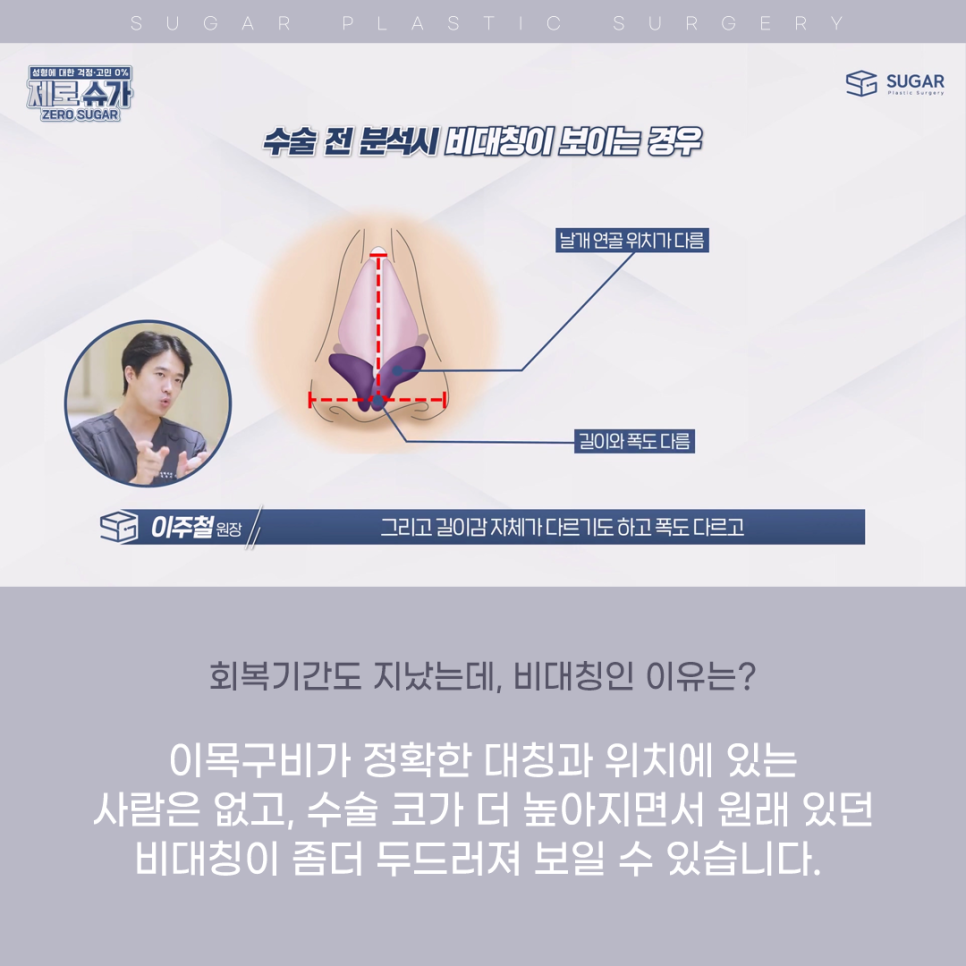 코 성형 후 콧구멍 짝짝이가 되었다?! 관련 이미지 4