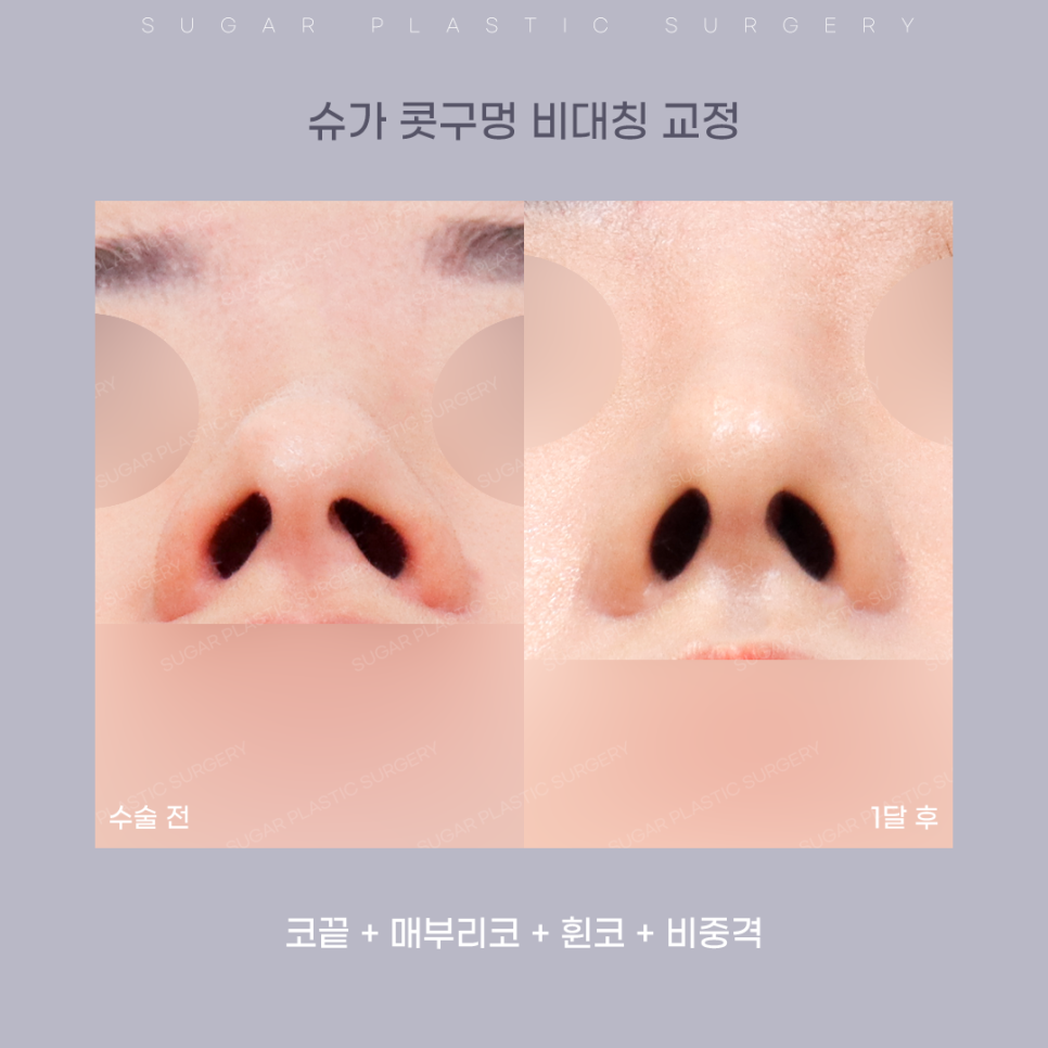 코 성형 후 콧구멍 짝짝이가 되었다?! 관련 이미지 9
