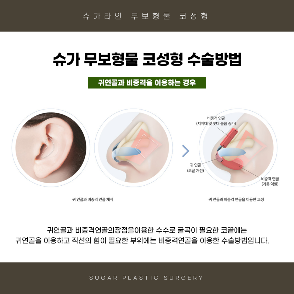 무보형물 코수술 슈가성형외과 관련 이미지 5