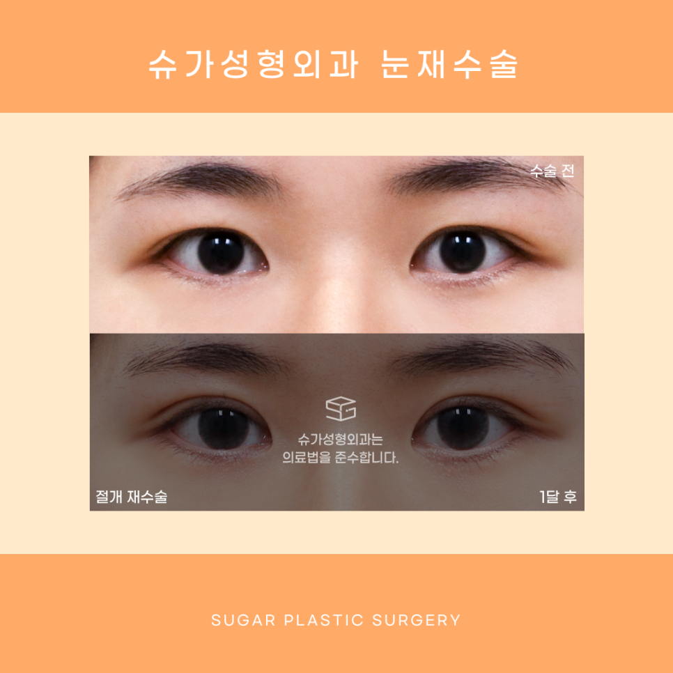 눈재수술 최대 몇 번까지 가능할까? 관련 이미지 7