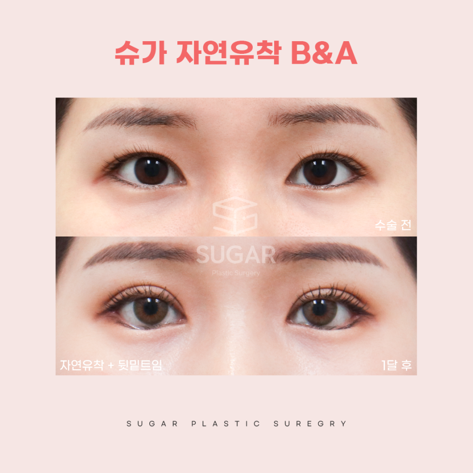 연예인쌍수라인으로 보는 쌍꺼풀라인 관련 이미지 9