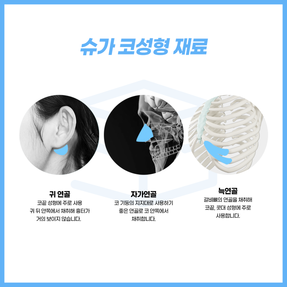 코성형 보형물 어떤게 있을까? 관련 이미지 2