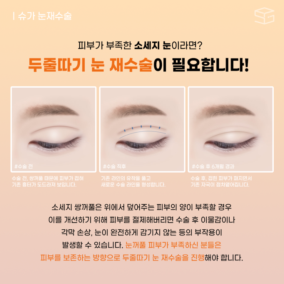 두줄따기 고민된다면? 관련 이미지 3