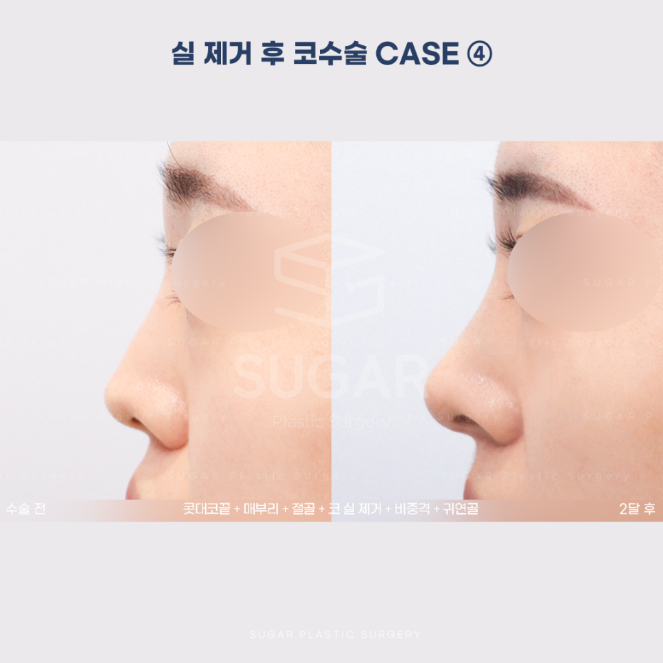 [슈가성형외과] 이런 코시술 하지마세요 관련 이미지 20