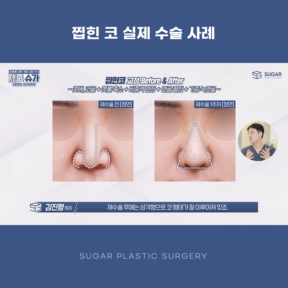 찝힌코 왜 생기는 걸까? 관련 이미지 13
