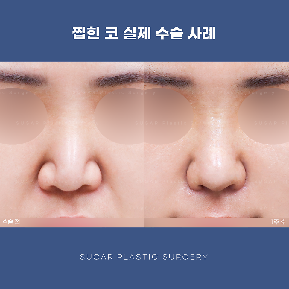 찝힌코 왜 생기는 걸까? 관련 이미지 11