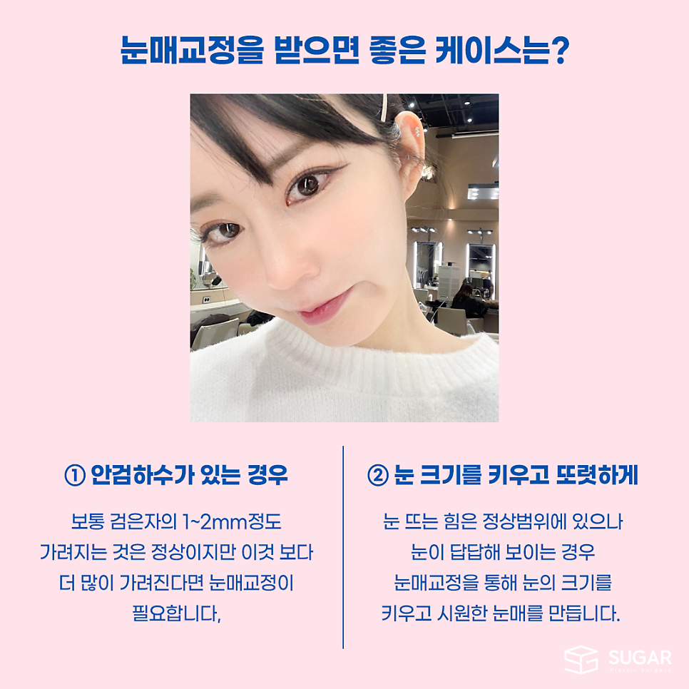 비절개눈매교정 VS 절개눈매교정 관련 이미지 11