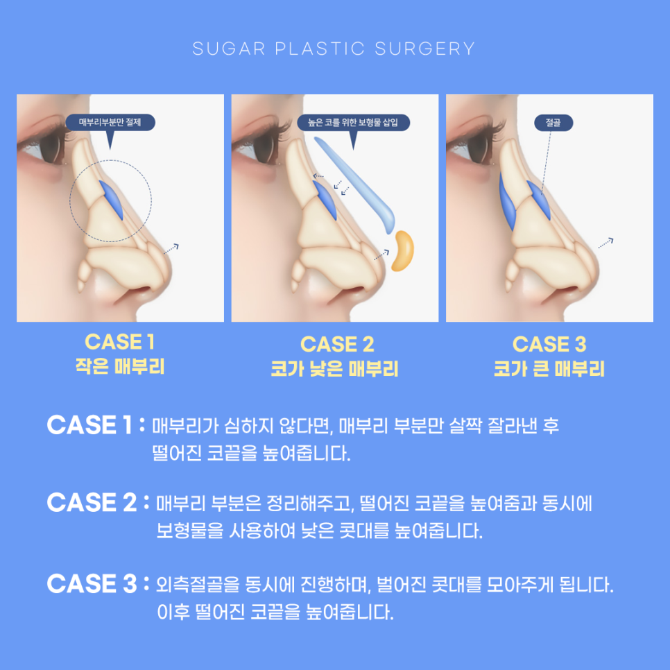 매부리코수술 매끄러운 라인으로 관련 이미지 4