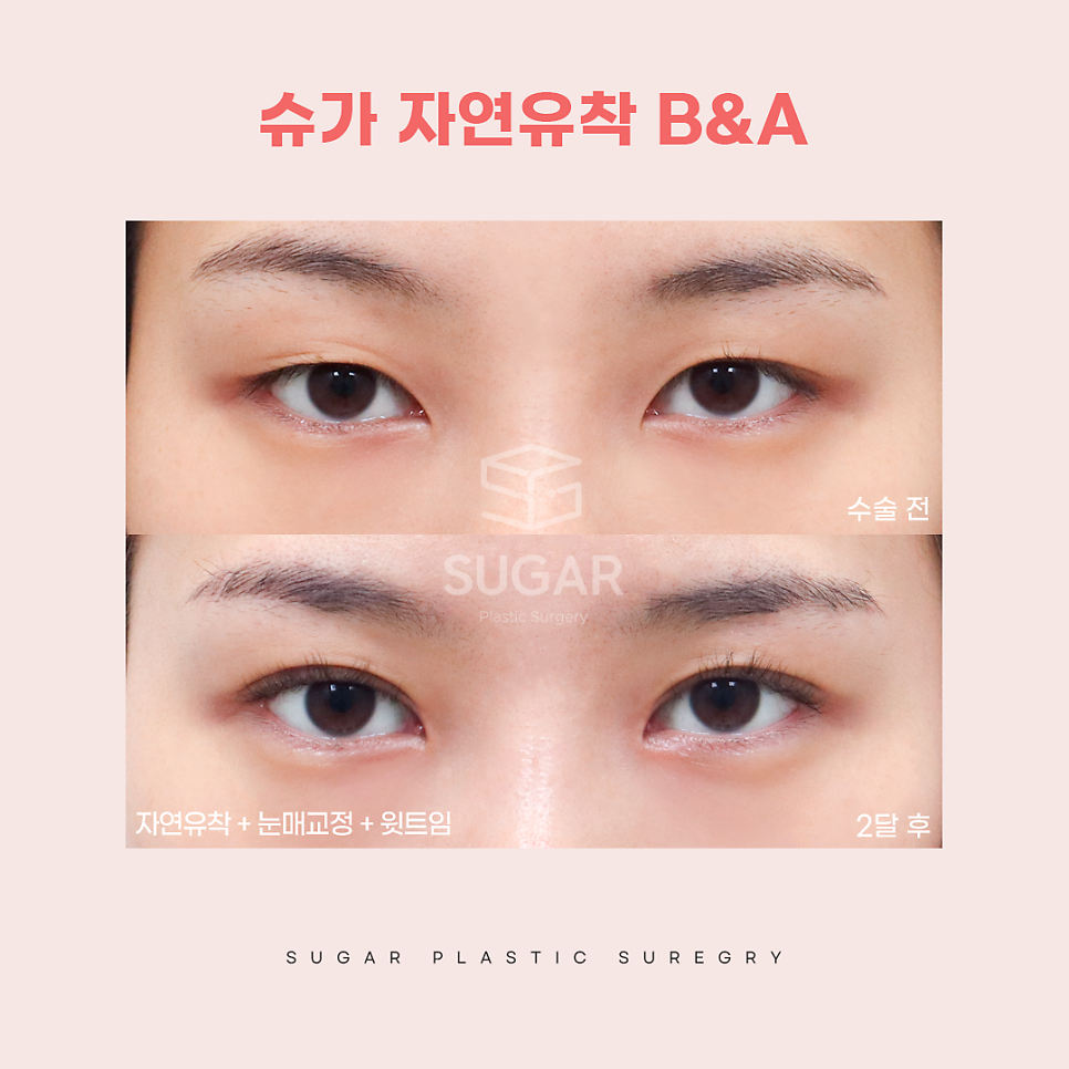 연예인쌍수라인으로 보는 쌍꺼풀라인 관련 이미지 11