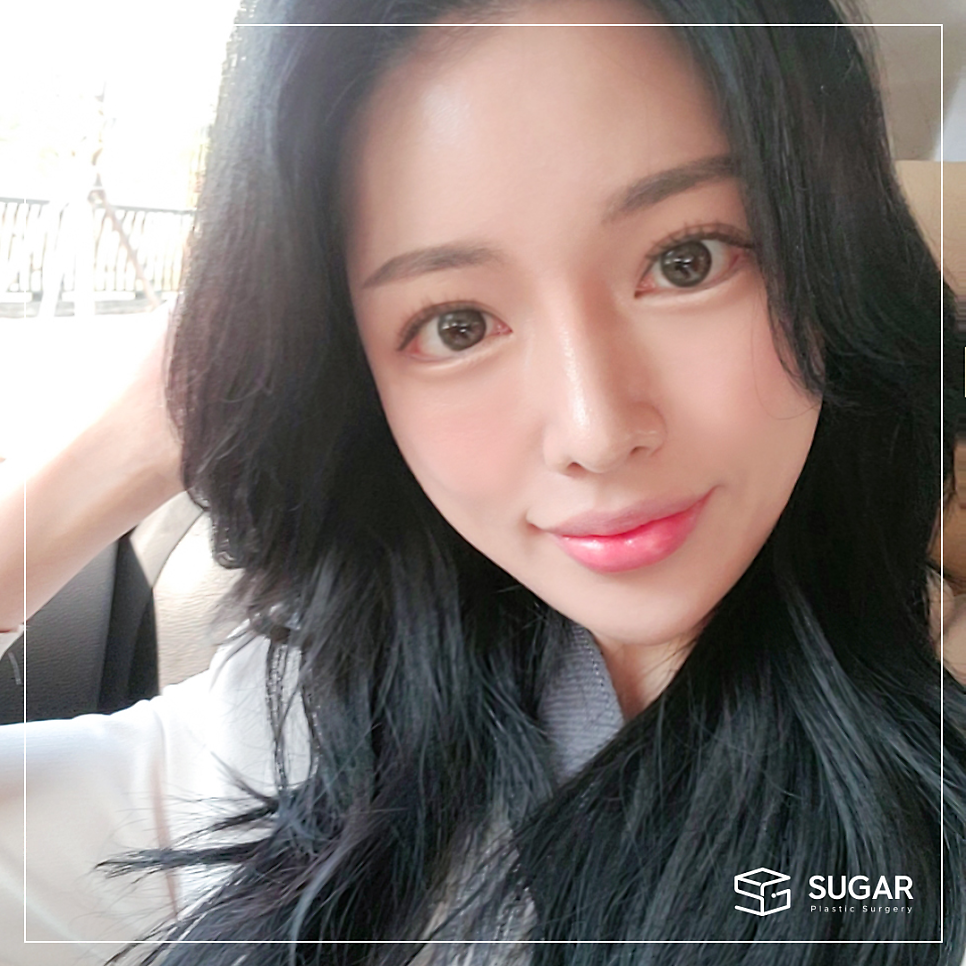 비절개눈매교정 VS 절개눈매교정 관련 이미지 8