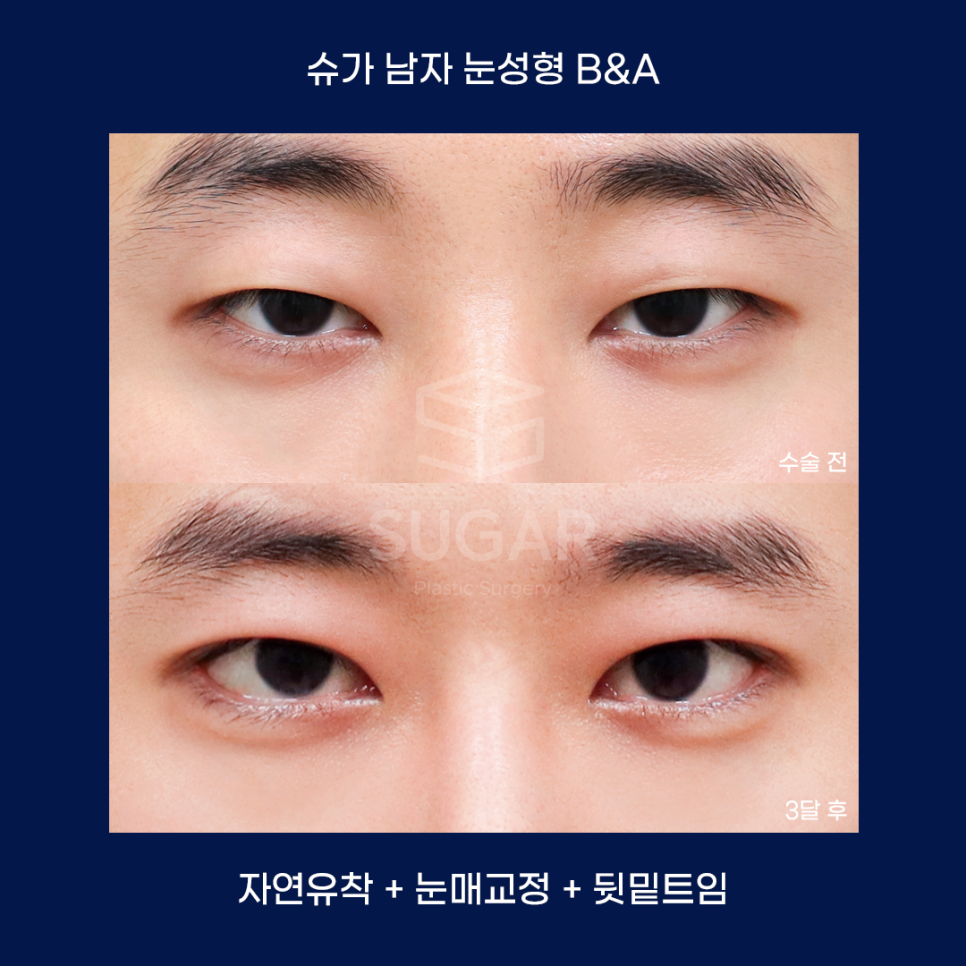 남자성형에 관한 궁금한 점 다 알려드립니다! 관련 이미지 13