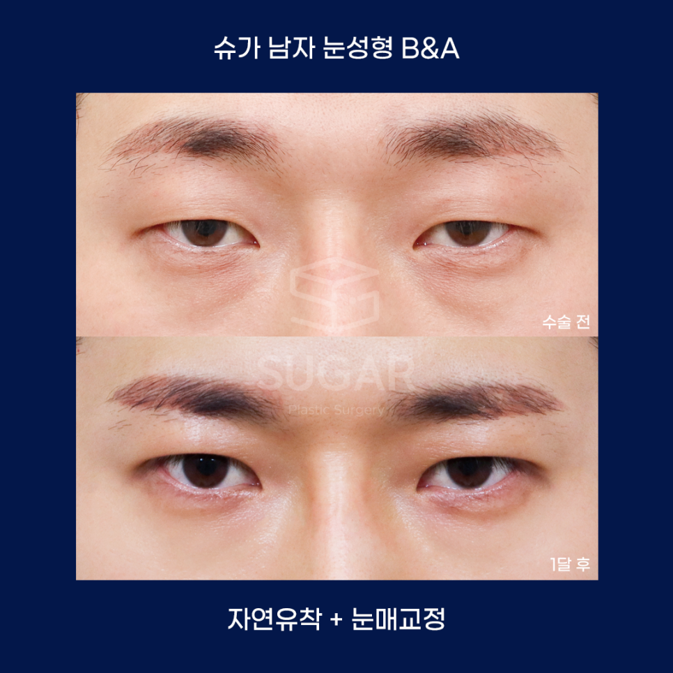 남자성형에 관한 궁금한 점 다 알려드립니다! 관련 이미지 11