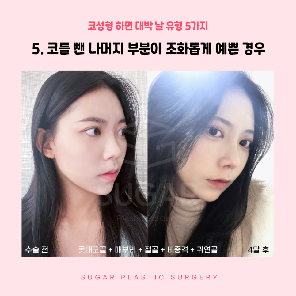 코성형 대박나는 코 관련 이미지 10