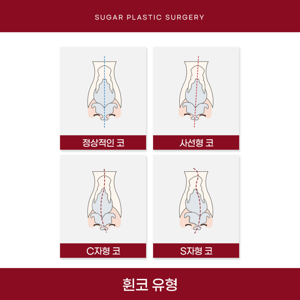 휜코 성형 알아보고 있다면 관련 이미지 7