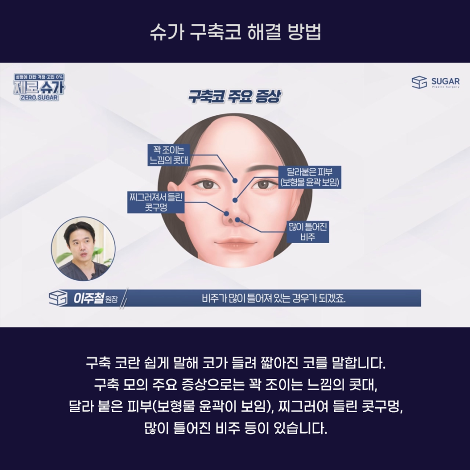 코재수술의 끝판왕, 구축코 케이스와 해결방법 관련 이미지 2