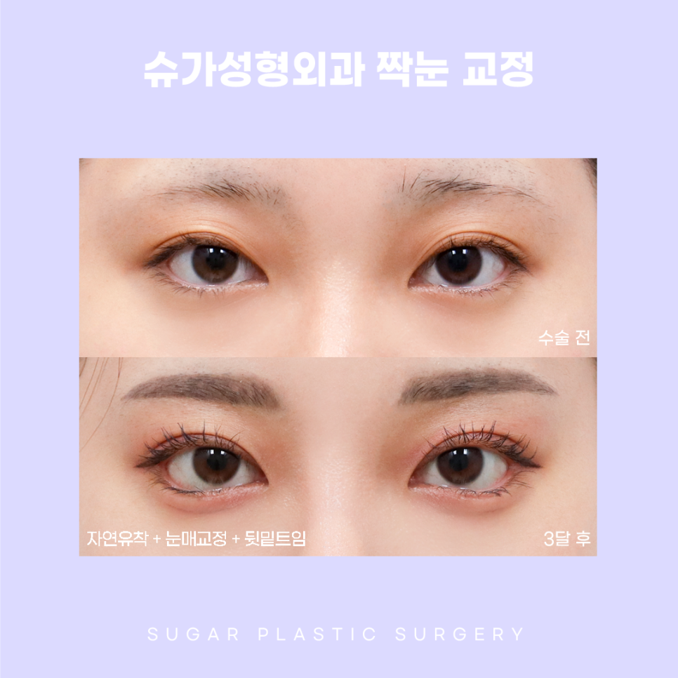 짝눈 교정 종류부터 해결까지 관련 이미지 9