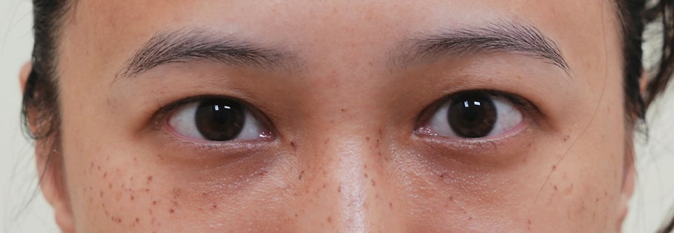 [눈성형] 너무 큰 쌍꺼풀, 그리고 잘 안 떠지는 왼쪽 눈 관련 이미지 3