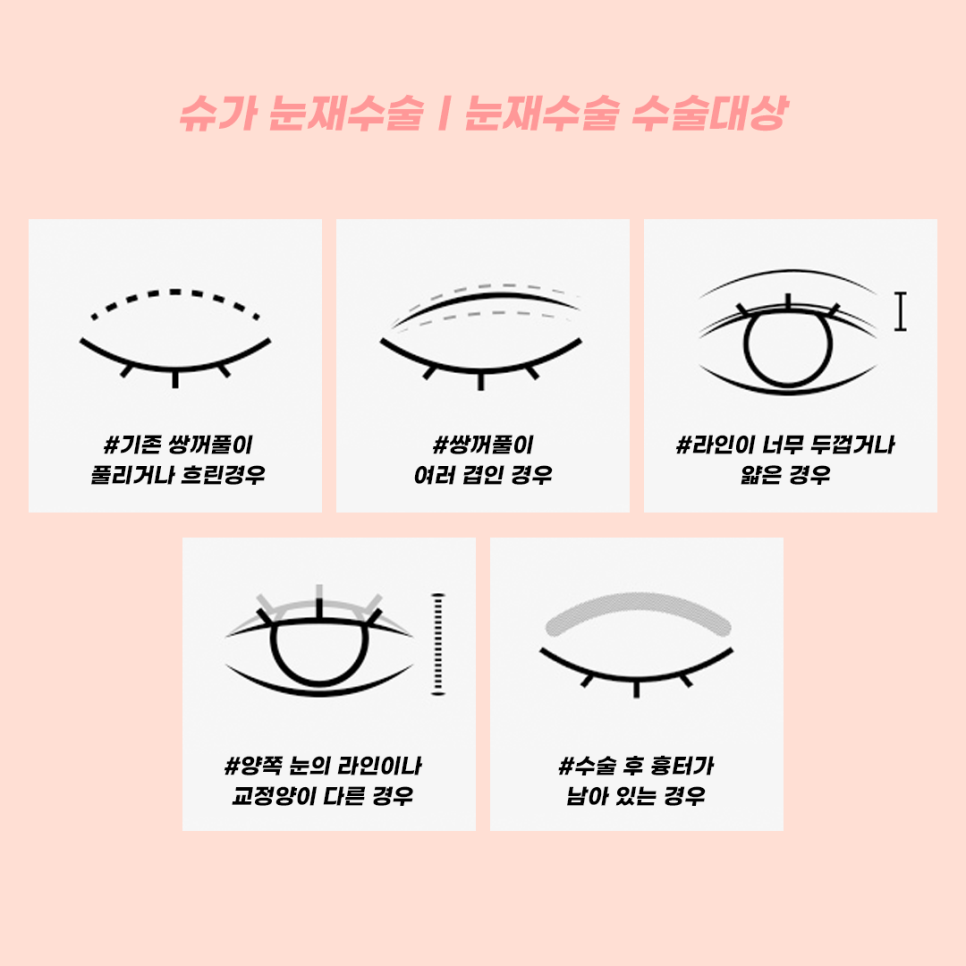 눈재수술 라인높이는 방법 관련 이미지 8