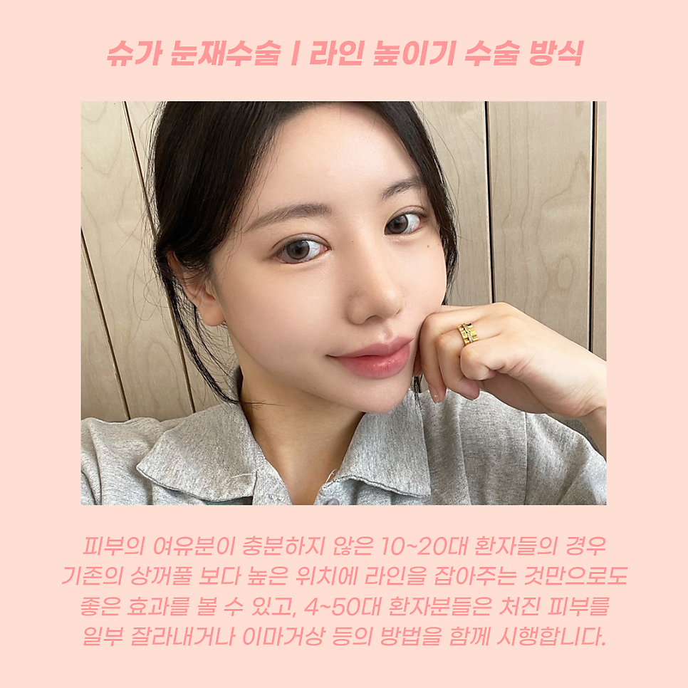 눈재수술 라인높이는 방법 관련 이미지 4