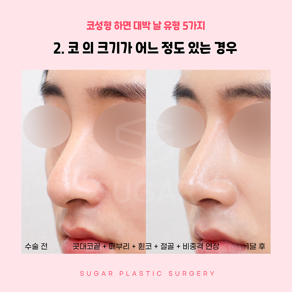 코성형 대박나는 코 관련 이미지 4