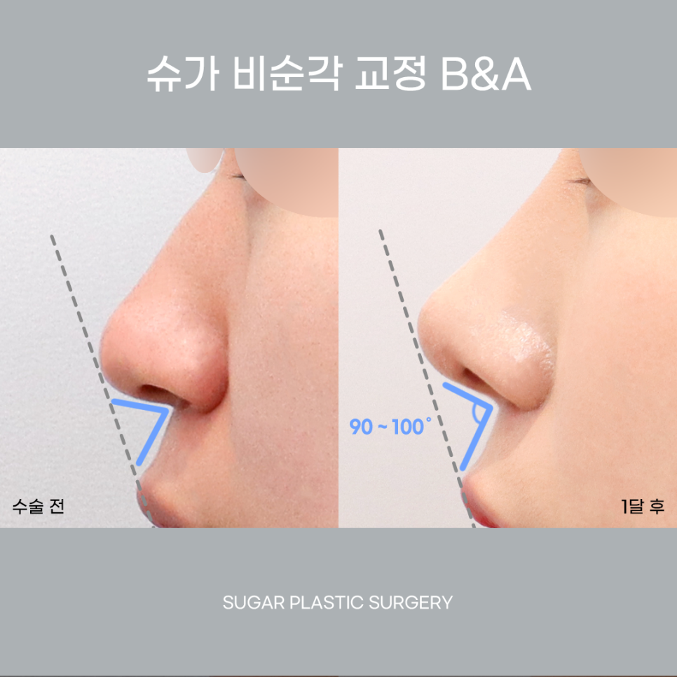 비주와 비순각교정 어떻게 할까? 관련 이미지 9