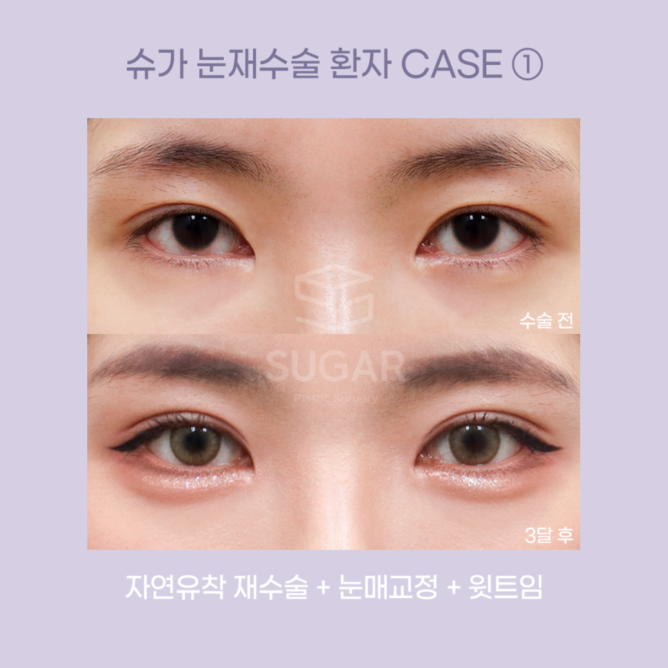 [슈가성형외과] 눈성형 실패하는 이유! 관련 이미지 7