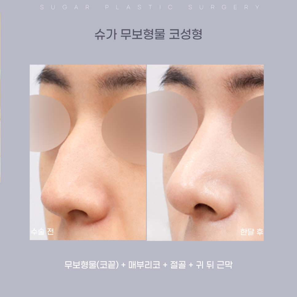 코끝만 올려주세요(feat 무보형물 코성형) 관련 이미지 8