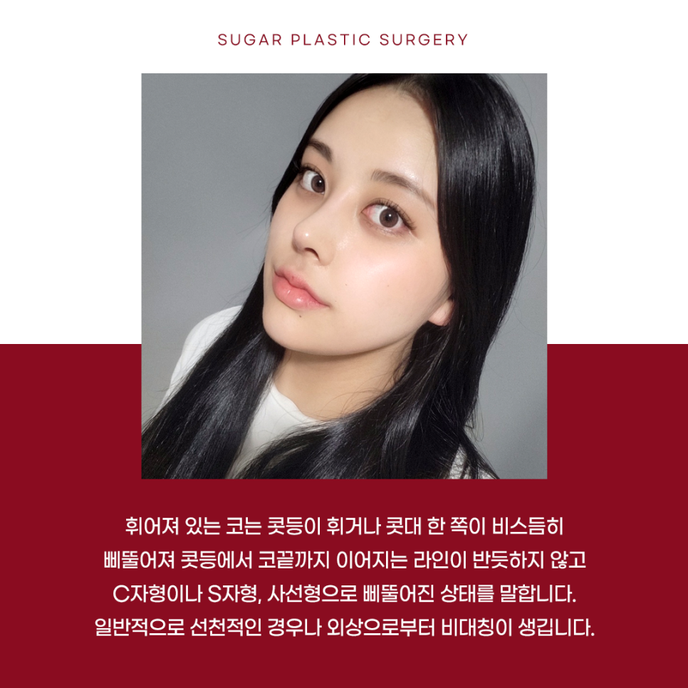 휜코 성형 알아보고 있다면 관련 이미지 5