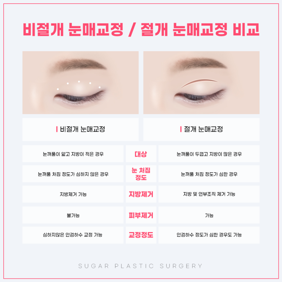 눈매교정 꼭 해야할까? 관련 이미지 5