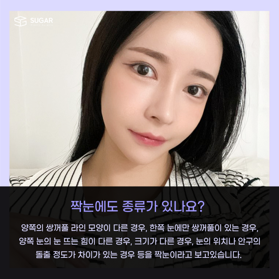 짝눈 교정 종류부터 해결까지 관련 이미지 2