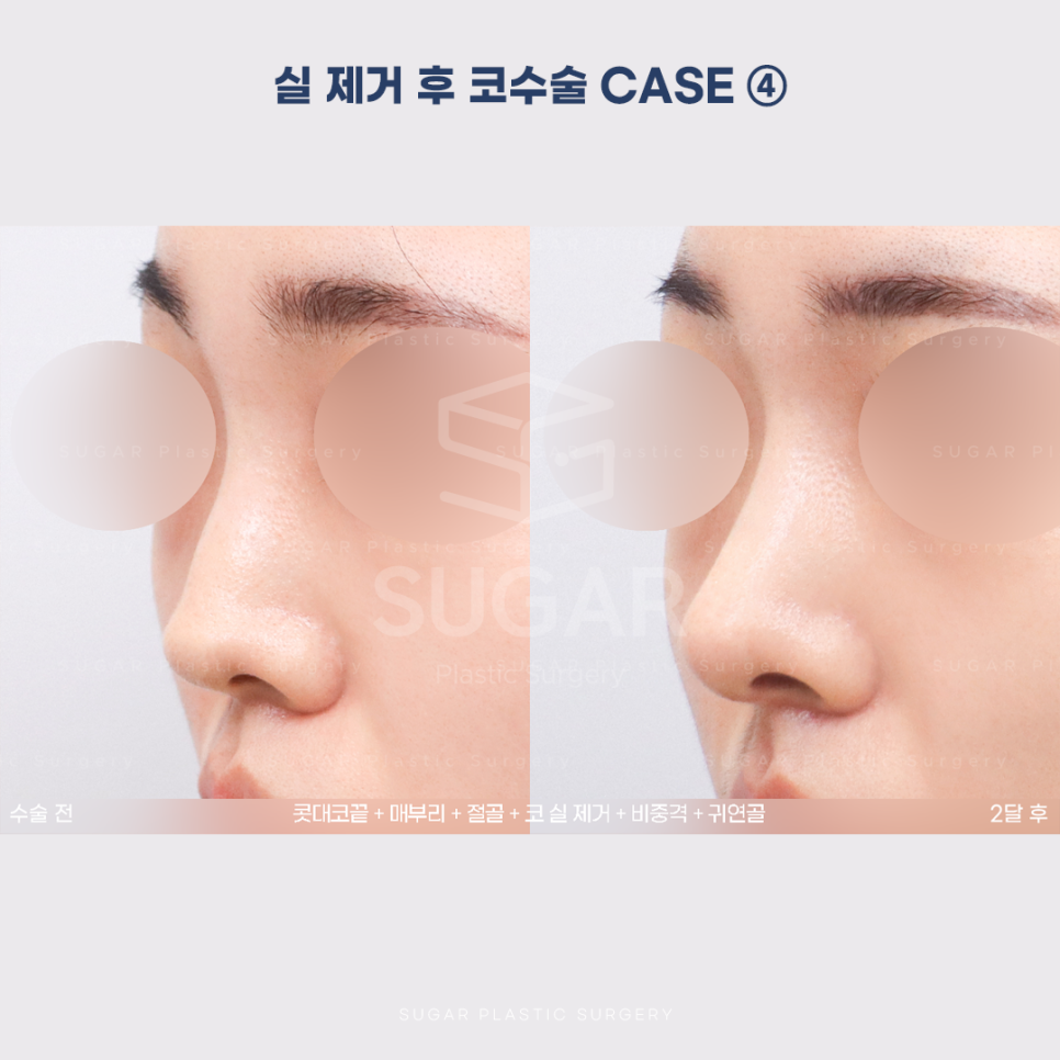 [슈가성형외과] 이런 코시술 하지마세요 관련 이미지 19