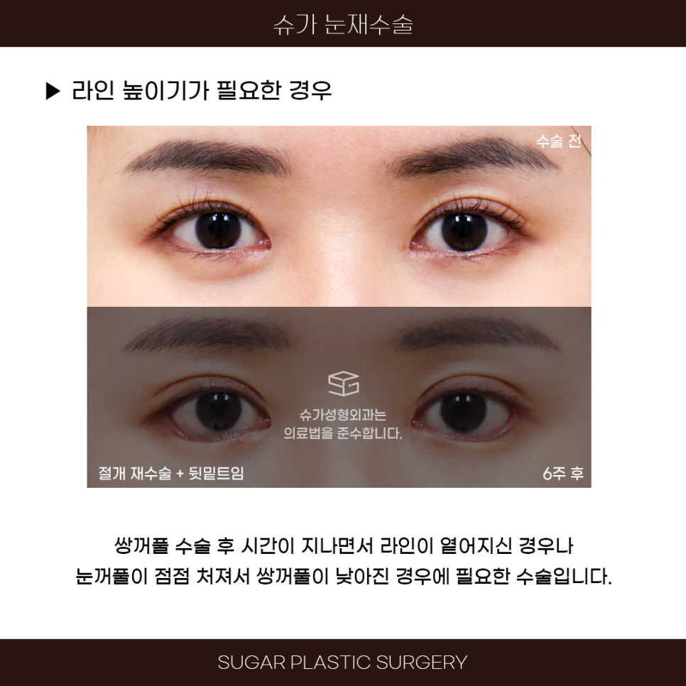 라인높이기 눈재수술 이것만은 알고가자 관련 이미지 3