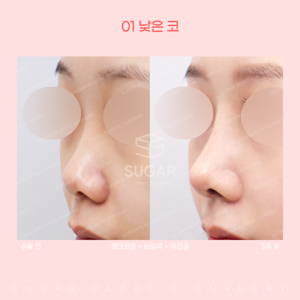 코 유형에 따른 코성형 방법 관련 이미지 5