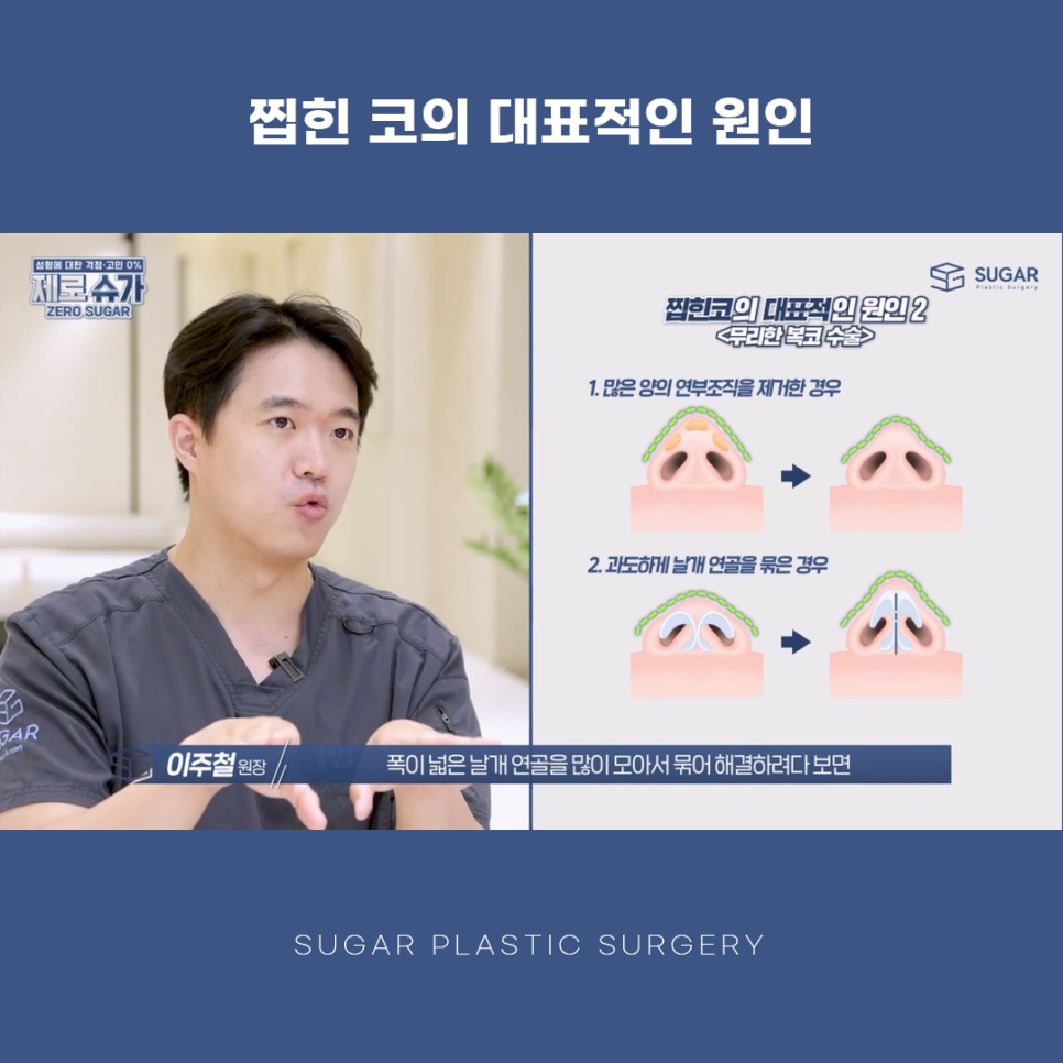 찝힌코 왜 생기는 걸까? 관련 이미지 5