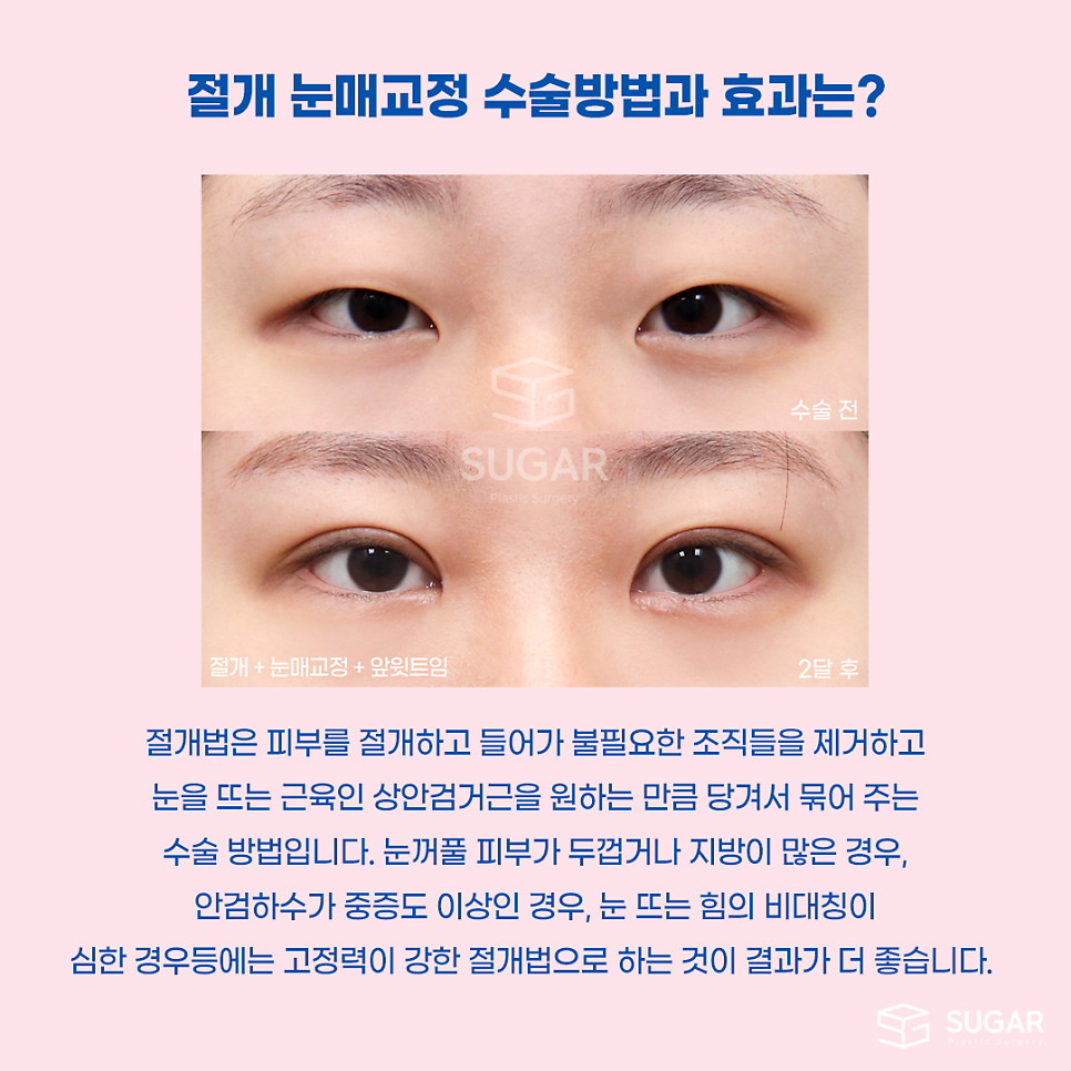 비절개눈매교정 VS 절개눈매교정 관련 이미지 7