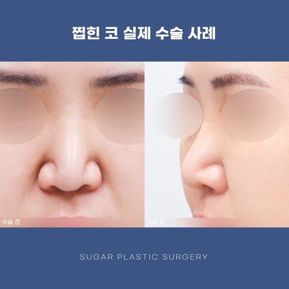 찝힌코 왜 생기는 걸까? 관련 이미지 9