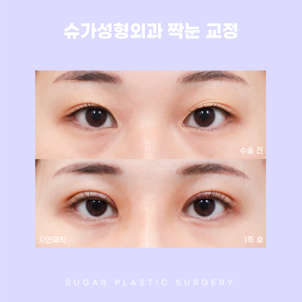 짝눈 교정 종류부터 해결까지 관련 이미지 7