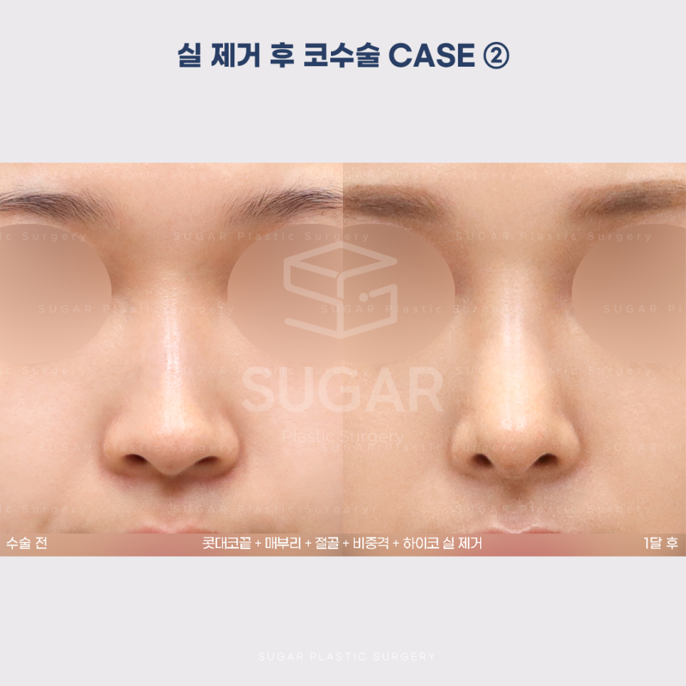 [슈가성형외과] 이런 코시술 하지마세요 관련 이미지 9