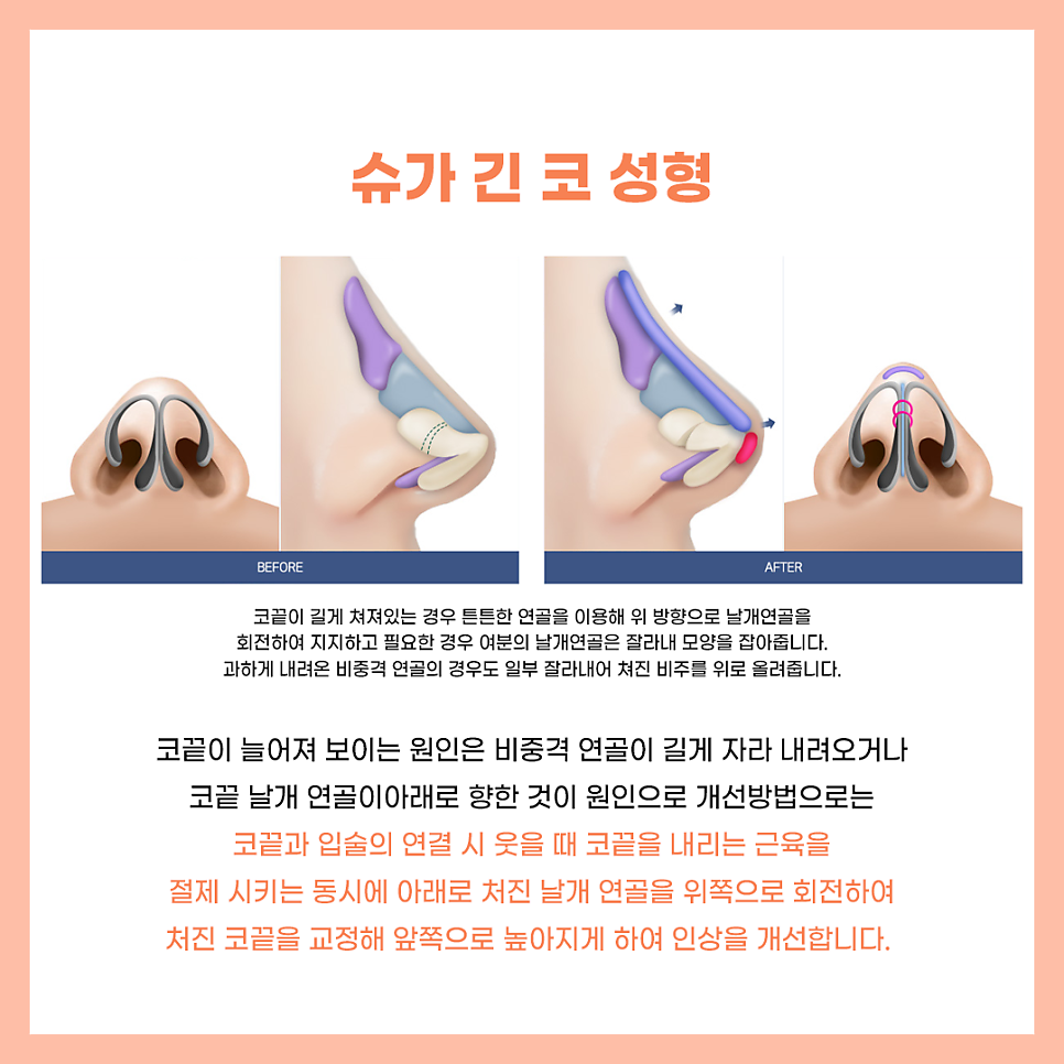 코수술잘하는곳 알아보고 있다면? 관련 이미지 6