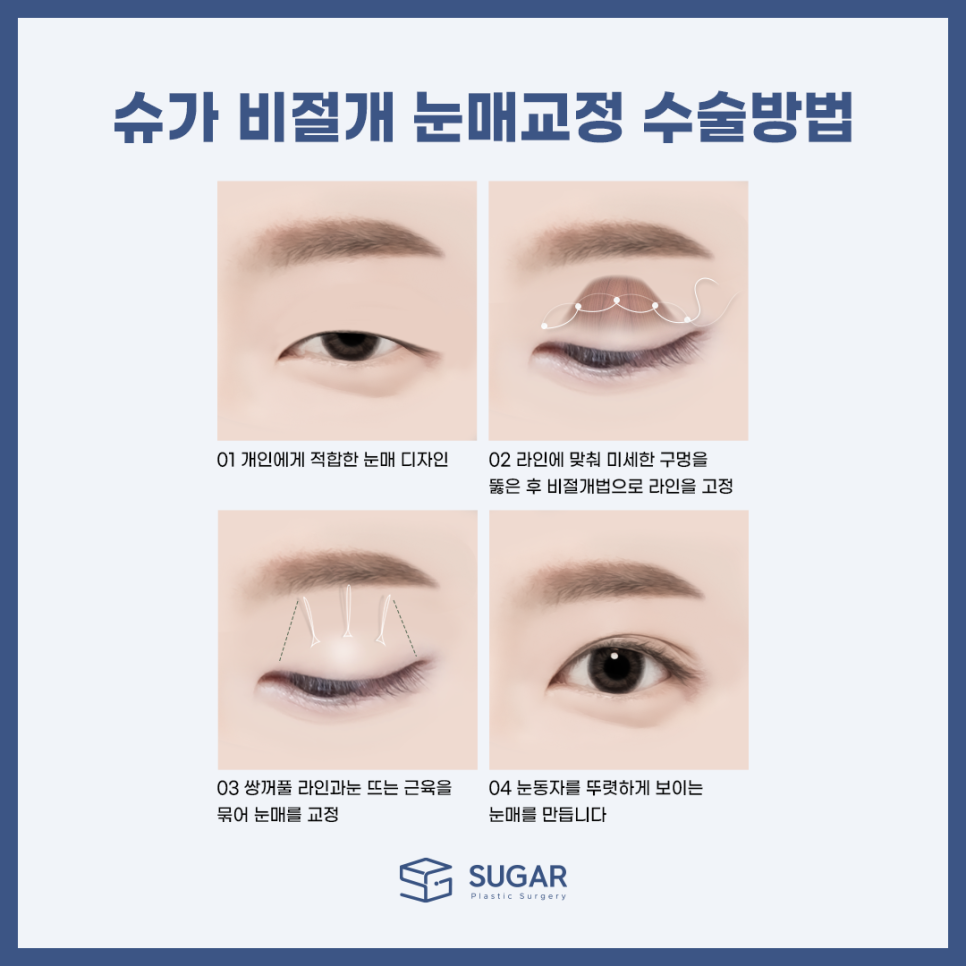남자눈성형 뭐가 다를까? 관련 이미지 6