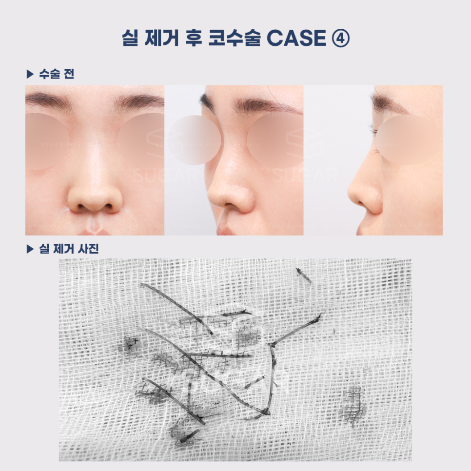 [슈가성형외과] 이런 코시술 하지마세요 관련 이미지 17