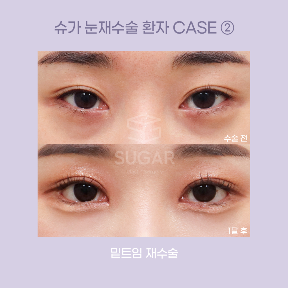 [슈가성형외과] 눈성형 실패하는 이유! 관련 이미지 8