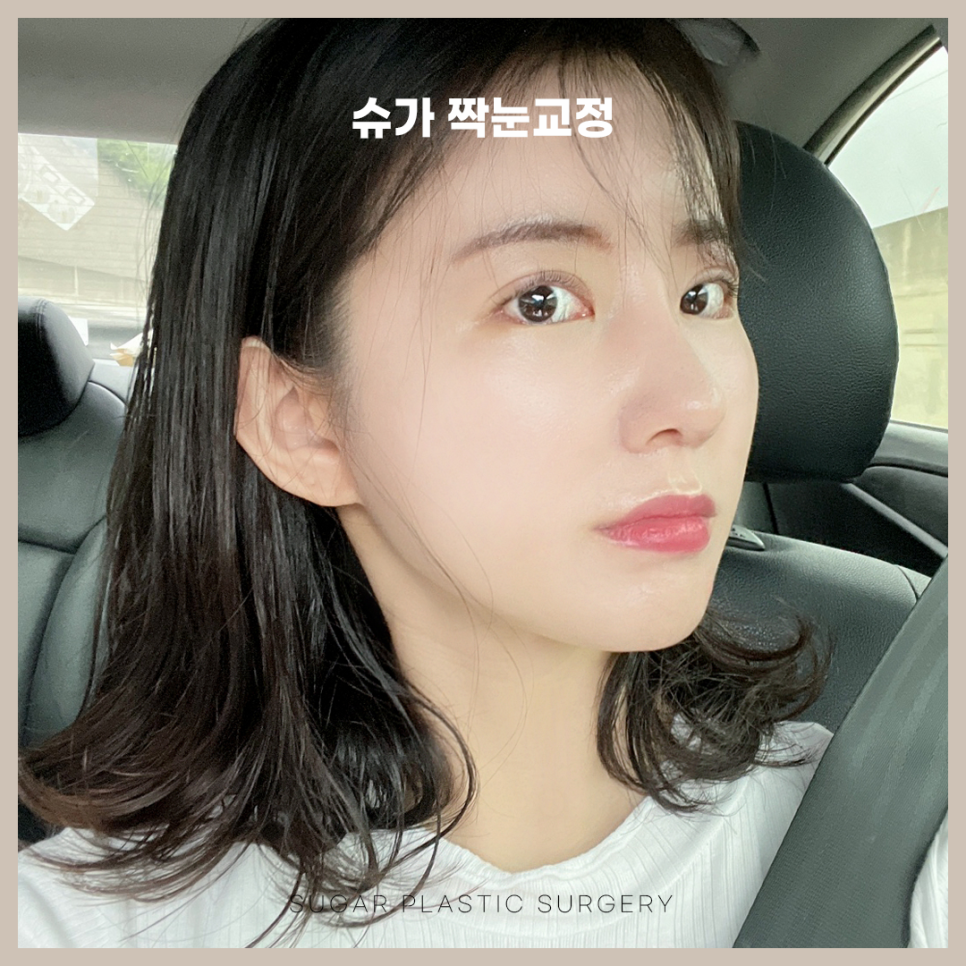 짝눈교정 어떻게 알아볼까 관련 이미지 5