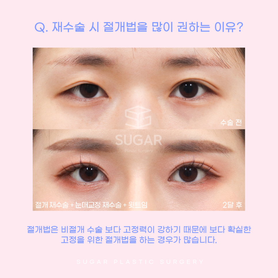 눈재수술 비절개로 가능할까? 관련 이미지 2