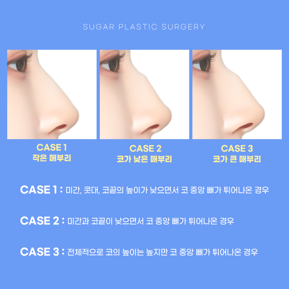 매부리코수술 매끄러운 라인으로 관련 이미지 3