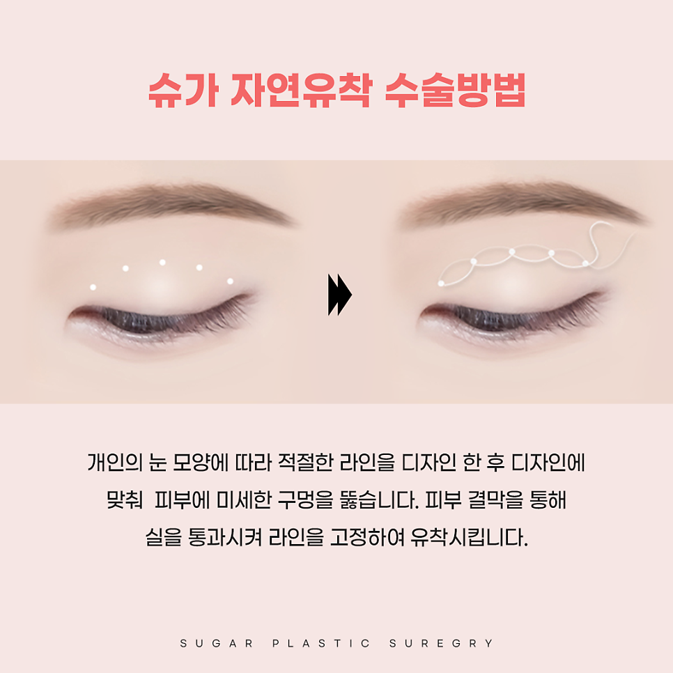 연예인쌍수라인으로 보는 쌍꺼풀라인 관련 이미지 7