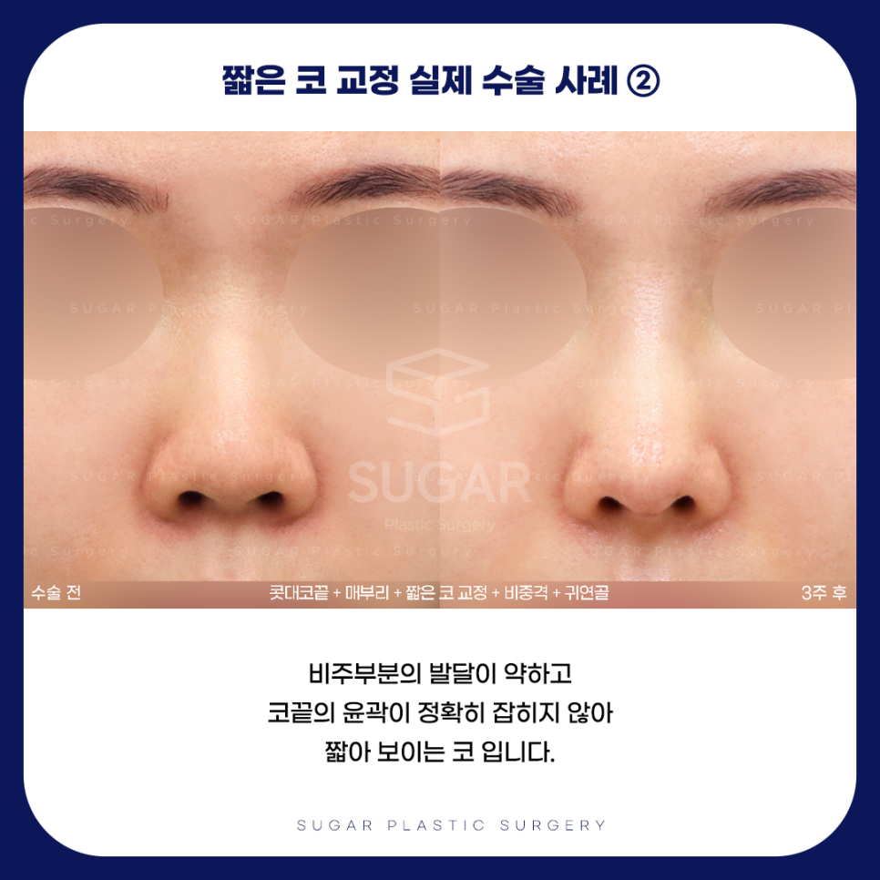 긴코 VS 짧은코 관련 이미지 15