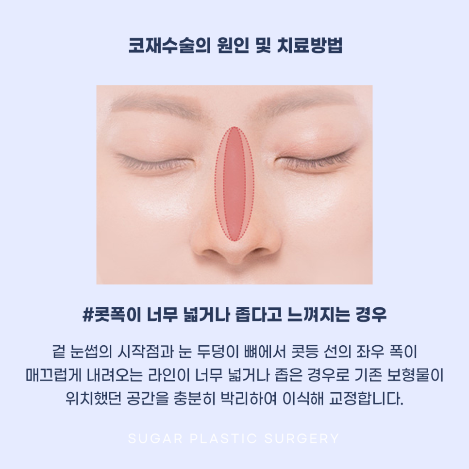 코재수술 그 유형과 해결방법은? 관련 이미지 7