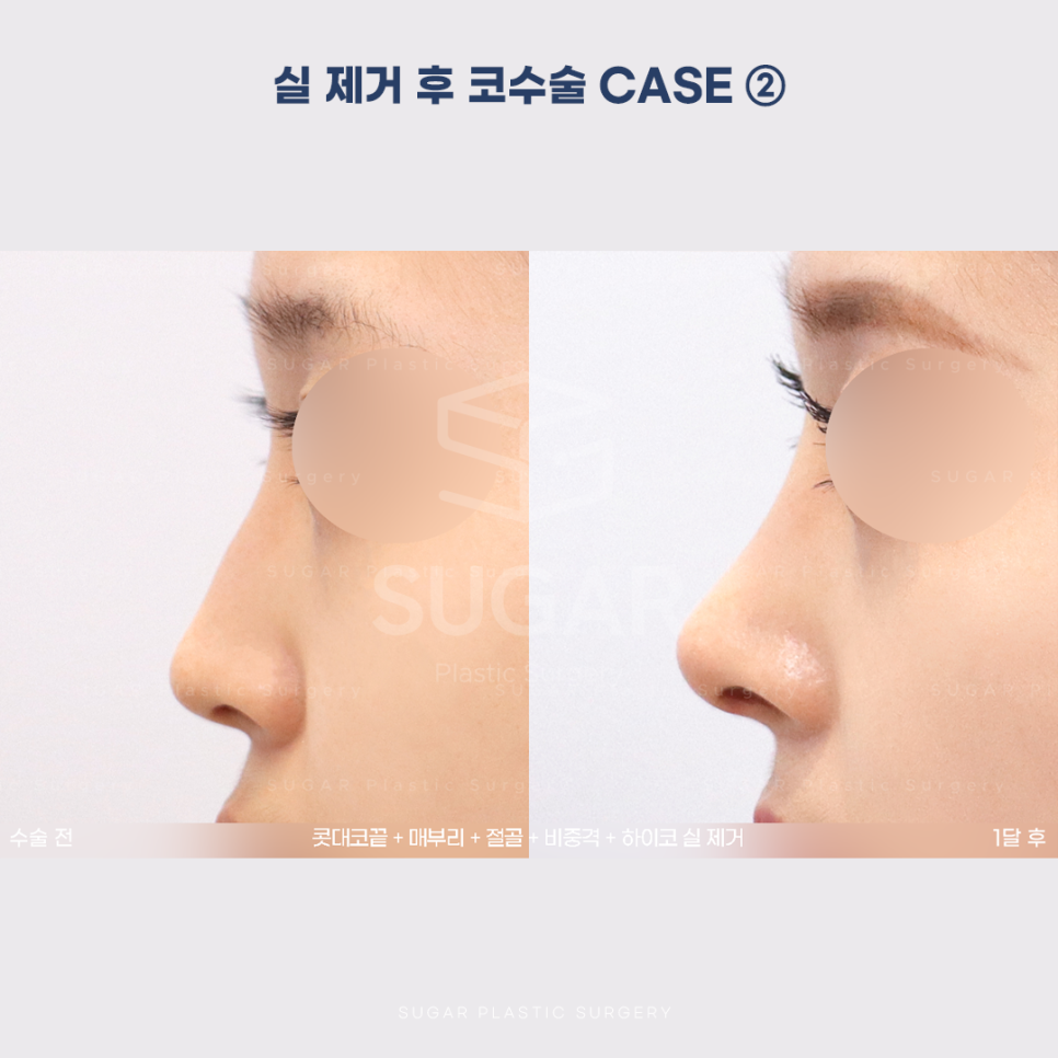 [슈가성형외과] 이런 코시술 하지마세요 관련 이미지 11
